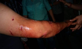 As&iacute; qued&oacute; el brazo de la v&iacute;ctima 